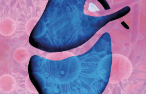 Pericarditis purulenta por Mycobacterium tuberculosis y Streptococcus pneumoniae. Revisión del tema, a propósito de un caso