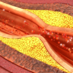 Hipertrigliceridemia severa durante el embarazo