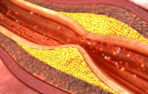 Hipertrigliceridemia severa durante el embarazo