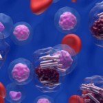 Diagnóstico por citometría de flujo de paciente con leucemia linfoide crónica