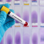 MEDICIÓN DE B-HIDROXIBUTIRATO DIAGNÓSTICO CLAVE PARA TRASTORNOS METABÓLICOS