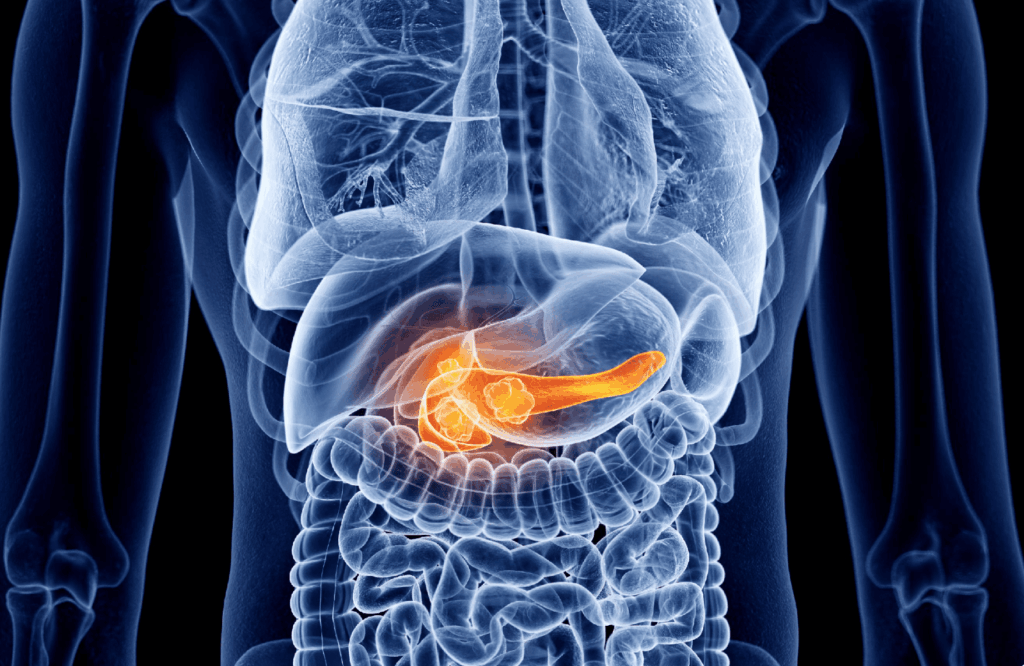 La pancreatitis aguda (PA) inducida por hipertrigliceridemia (HTG) secundaria a déficit de insulina en el contexto de un debut de diabetes mellitus tipo 1 (DM1) es una complicación infrecuente pero grave en niños.