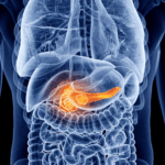 La pancreatitis aguda (PA) inducida por hipertrigliceridemia (HTG) secundaria a déficit de insulina en el contexto de un debut de diabetes mellitus tipo 1 (DM1) es una complicación infrecuente pero grave en niños.