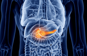 La pancreatitis aguda (PA) inducida por hipertrigliceridemia (HTG) secundaria a déficit de insulina en el contexto de un debut de diabetes mellitus tipo 1 (DM1) es una complicación infrecuente pero grave en niños. 